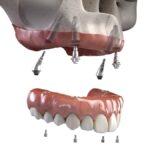 Implant Dental Works - Photo 4